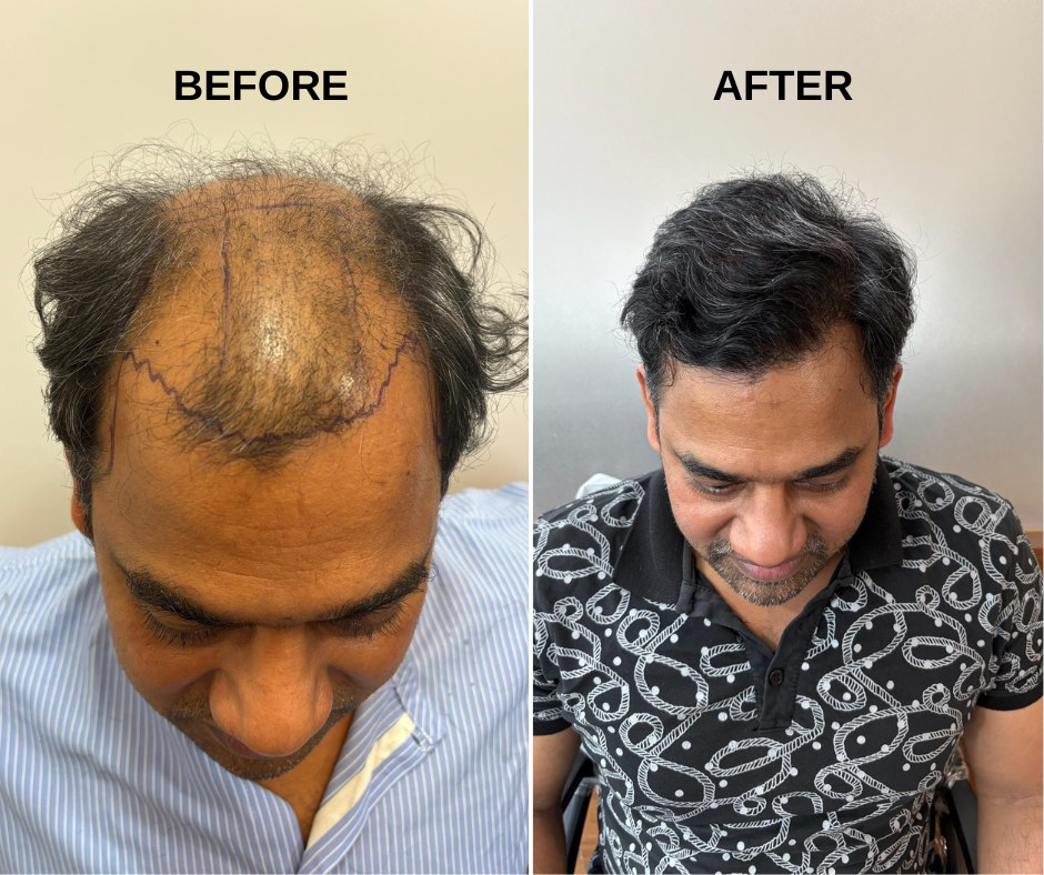 Natural hairline design hair transplant before after Mumbai