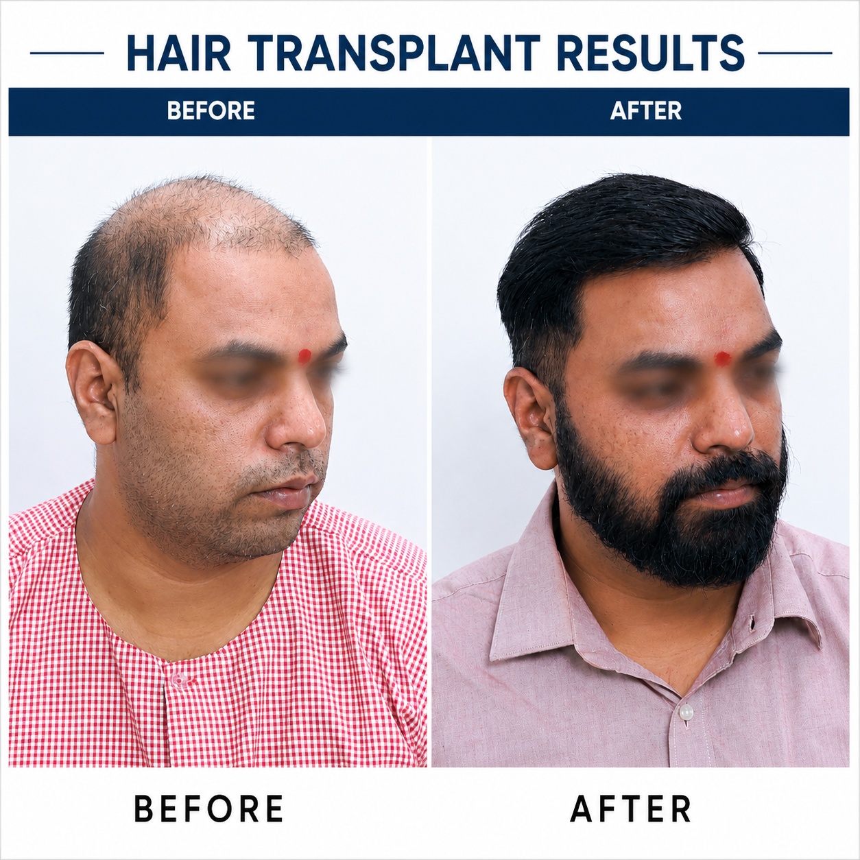 Hair transplant result 3
