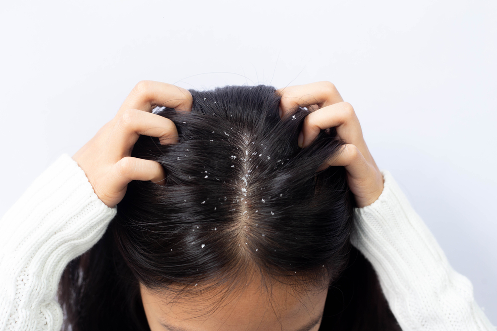 dandruff treatment