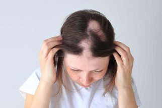 Alopecia Areata ​